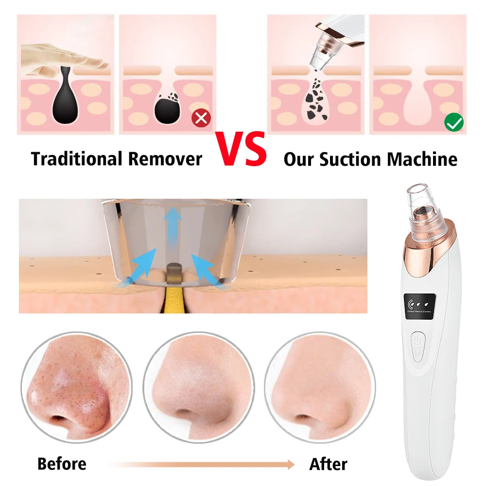 Electric Facial Skin Care Pore Removal Cleanser - Blackhead & Acne remover - BluePeak Ventures